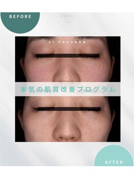 エーティーセンターラボ(At.center labo)/結果の出るシミプログラム