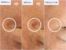 【シミ改善したい方】痛み最小のシミケア◎光当て放題でファンデの厚塗り卒業