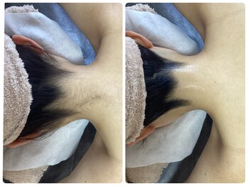 ルルトウキョウ 池袋店(LULU.tokyo)/うなじ脱毛