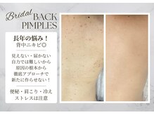 サロンドエリ ラクロワジエール(Salon d’ERI la Croisiere)/【背中ニキビ】ブライダルエステ