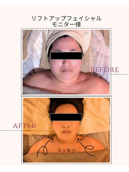 ブルーム(B.LOOM)/リフトアップフェイシャル