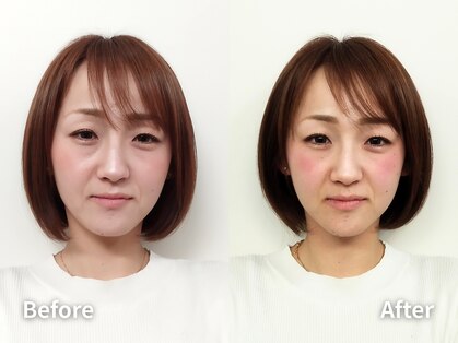 ゆうき式小顔矯正の写真