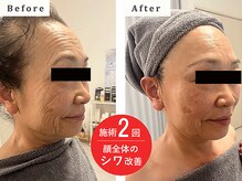 フワリ(fuwari)/施術2回★顔全体のシワ改善