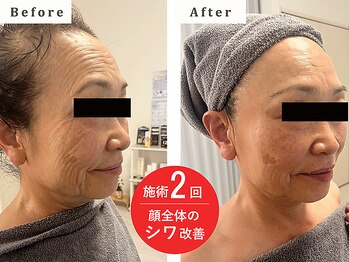フワリ(fuwari)/施術2回★顔全体のシワ改善