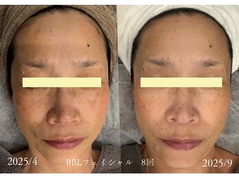 モミン(MOMI.N)の写真/シミもくすみもなかったことに、光の力で肌を一新し透明感あふれる美肌へ導くケア60分4500円