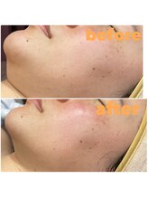 グロー(GLOW)/BBLフェイシャル