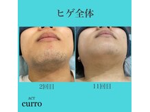 アクト クロ(ACT curro)/【ヒゲ全体】脱毛施術例