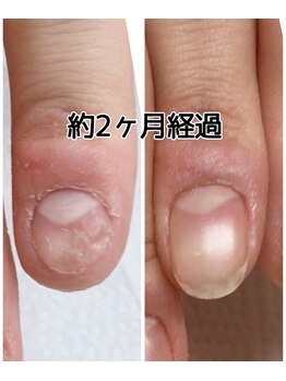 スマイルニコ(smile nico)/凸凹爪もツルツルになる！