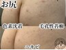 剥離あり【リベル】ハーブピーリング《お尻》2千円商品券付★黒ずみ等￥22000