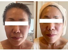 ルポ 那覇(repos)/電気美容鍼