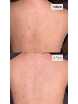 マリブバイメルティ(malibu by melty)/1回の施術でツヤと潤いUP♪