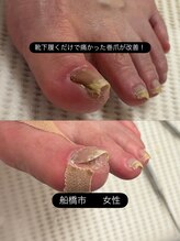 巻き爪じゅん 千葉駅前店/靴下も履けない巻き爪が改善