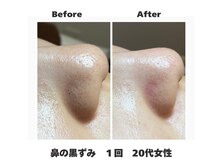 ラナン パラフューズ(Ranun's PARAFUSE.)/毛穴ビフォーアフター（2）