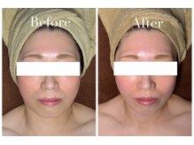 アブニールブリヨン/2BBioハーブピーリング/肌質改善