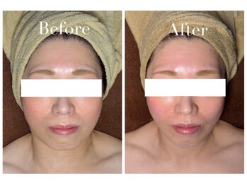 アブニールブリヨン/2BBioハーブピーリング/肌質改善