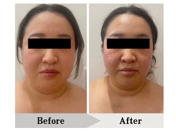 エミット(emit.)/顔の脂肪分解