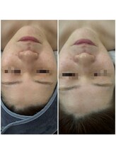 ファーファラ(Farfalla)/ハーブピーリング