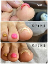 一宮巻き爪センター/巻き爪