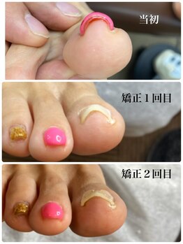 一宮巻き爪センター/巻き爪