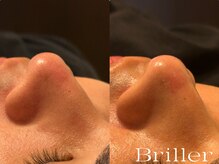 ブリエ(Briller)/毛穴洗浄＋鎮静パック