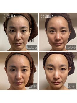 ヘリオス(helios+)/CPJビフォーアフター