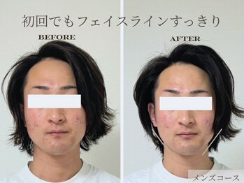 ミラ 長崎駅前店(MIRA)/小顔専門#造顔 #小顔矯正_タルミ