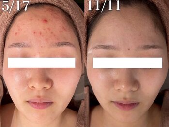 ハリト エステ(HaRi&)/毛穴洗浄/熊本/ハーブピーリング