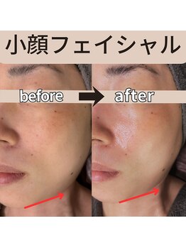 モーイエンチャーム(mooi en charme)/【ハリ・たるみ・シワ】顔のみ