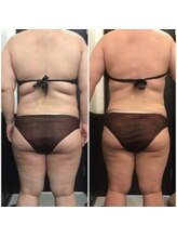 カンフリエ 吉野ヶ里店(Camphrier)/【痩身】ビフォーアフターご紹介