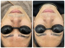 フォルチェ ゆめタウン広島店(Folche)/メンズ顔脱毛12回の結果