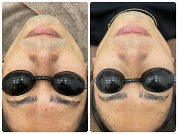 フォルチェ ゆめタウン広島店(Folche)/メンズ顔脱毛12回の結果