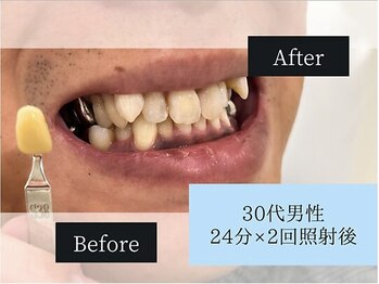 ホワイトニングカフェ 大宮西口店/◎歯のホワイトニング施術写真◎