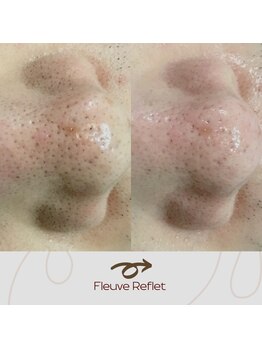 フルーヴ ルフレ(Fleuve Reflet)/男性の毛＋角栓毛穴にも人気☆