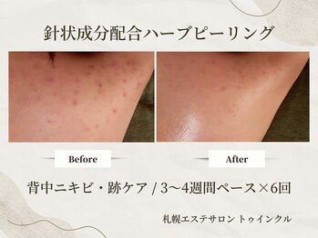プライベートエステサロン トゥインクル/残ってしまった跡ケアにも◎