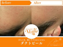 まいれ鍼灸院整骨院 整体院 草津院/ダクトピール/肌のざらつき/赤み