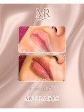 エスペランサ(Esperanza)/リップピンクメラニンケア