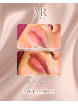 エスペランサ(Esperanza)/リップピンクメラニンケア