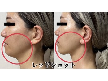 毛穴専科の写真/＼韓国式Vリフト小顔管理が破格の￥4,980／リピート率86％「効果にびっくり」二重顎、顔太りでお悩みの方へ