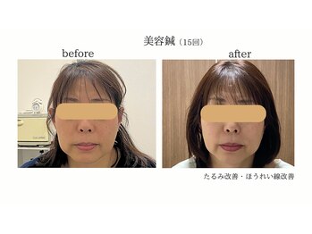 アボット(ABBOTT)/美容鍼15回 40代