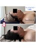 【骨格小顔】頭蓋骨矯正＋モンテフェイシャル80分/目/二重アゴ/面長/シワ改善