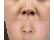 ルミエール パークサイド(L’MIERE parkside)/毛穴ケアによる開き毛穴の肌変化