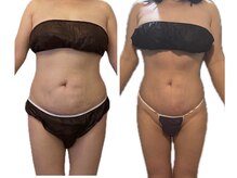 キュール(KuhL)/痩身ビフォーアフター☆