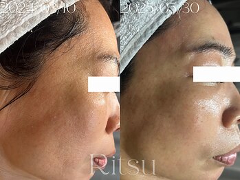 リツ(Ritsu)/シワ改善/たるみ改善