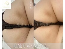 サロン ド レナ(Salon de LENA)/ハーブピーリング サロンドレナ
