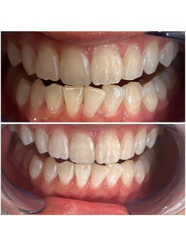 エクシアホワイトニング 代々木店/ホワイトニングビフォーアフター