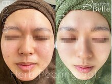 ベル 大森(Belle)/ ハーブピーリング｜ニキビケア