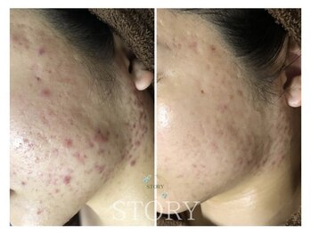 ストーリー 岐阜店(STORY)/ハーブピーリング専門店STORY