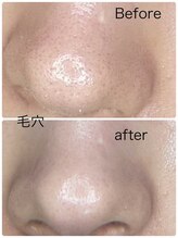 ルミネル 名古屋新栄(Luminelle)/毛穴洗浄