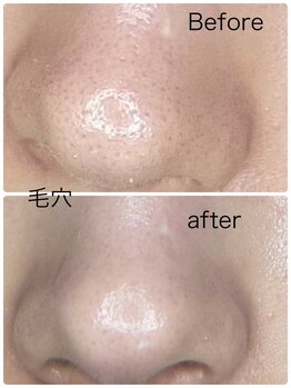 ルミネル 名古屋新栄(Luminelle)/毛穴洗浄