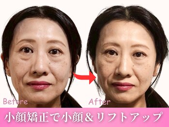 鍼灸整体院ワト 三軒茶屋院(鍼灸整体院WATO)/■小顔矯正(before→after)